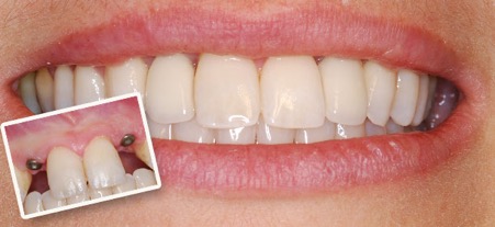 Single tooth dental implant at the Dental Excellence Centre for Cosmetic, Laser, and Implant Dentistry showing a high-quality implant placement for tooth replacement 