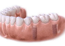 Illustration of a multiple unit dental implant bridge restoration at Dental Excellence Centre for Cosmetic, Laser and Implant Dentistry, showcasing several teeth implants and the supporting jawbone structure. 