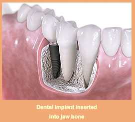 A detailed illustration of a dental implant procedure at the Dental Excellence Centre for Cosmetic, Laser, and Implant Dentistry, showing the process of placing a dental implant into the jawbone for tooth replacement. 